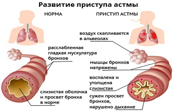 механизм развития астмы