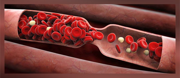 закупорка сосудов