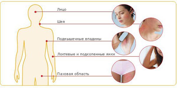 локализация атопического дерматита